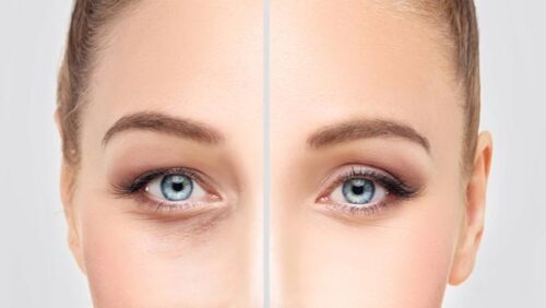 كل التفاصيل عن جراحة تجميل الجفون