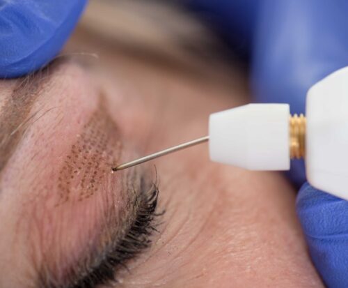 كلّ ما عليك معرفته حول تجميل الجفون بالليزر