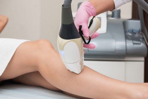تقنية إزالة الشعر بالليزر