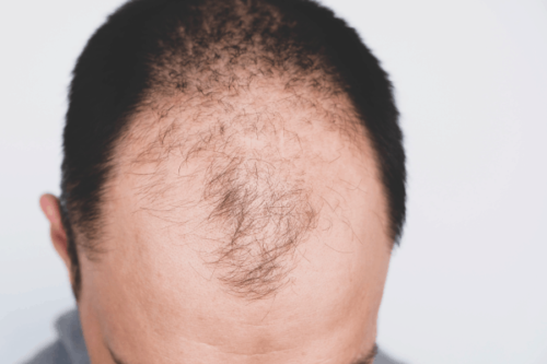حلول تساقط الشعر والصلع