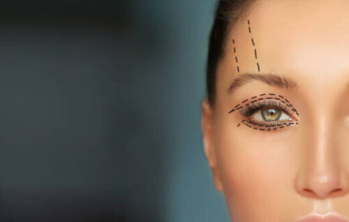 عمليّة تجميل الجفون