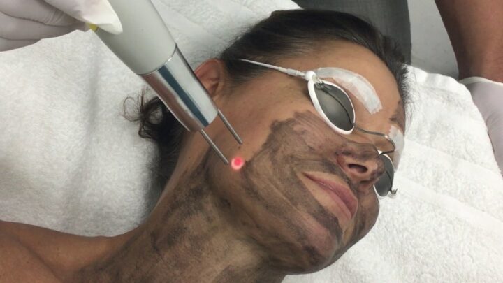 carbonic-laser