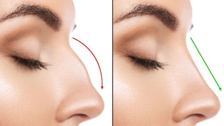عمليات-تجمل-الأنف